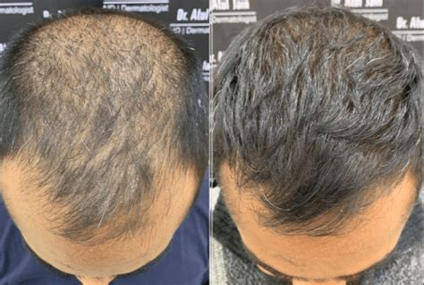 De Rol Van PRP In Haartransplantatie Procedures