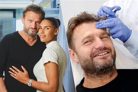 Een Stapsgewijze Gids Voor Haartransplantatie