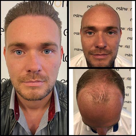 Effectieve Voorbereiding Voor Je Haartransplantatie