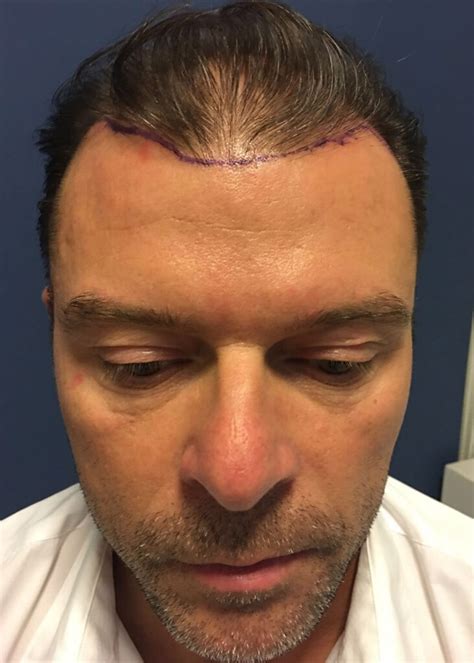 Haartransplantatie Trends Van 2023