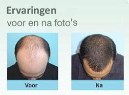 Vergelijking Van Haartransplantatie Klinieken In Europa